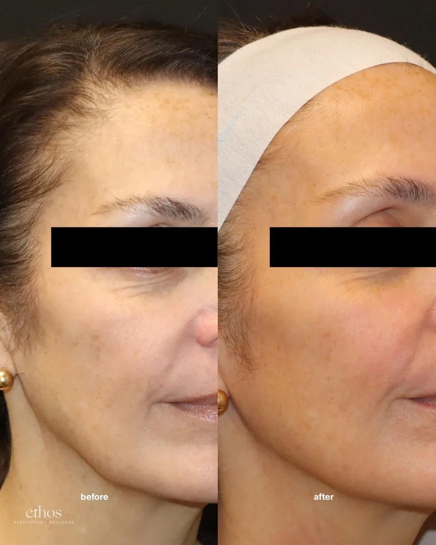 Sculptra before and after