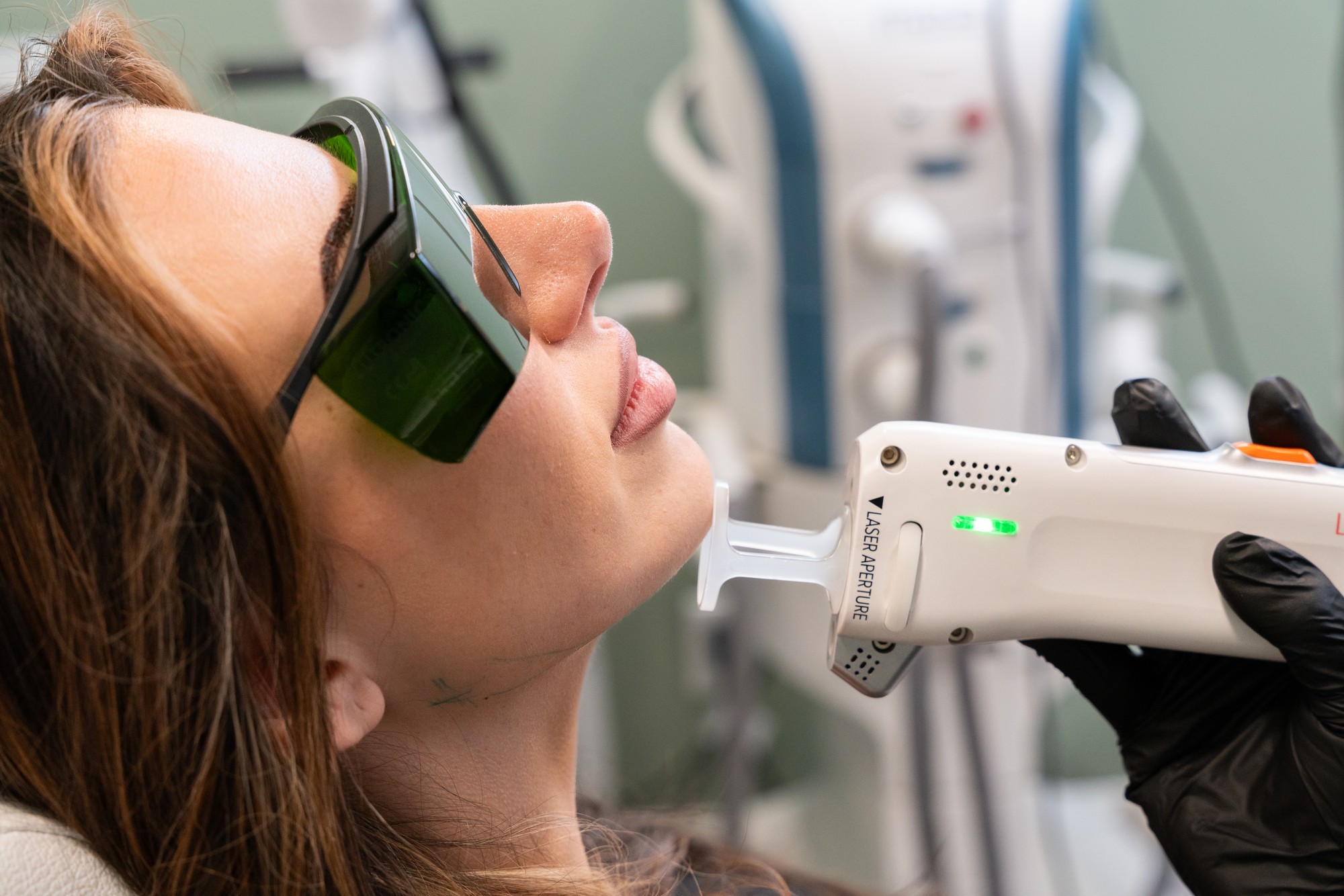 Laser hair removal treatment