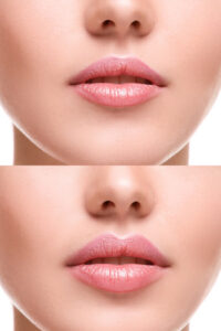 44235153 - female lips  before and after augmentation