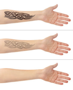 55688024 - tattoo on male hand. laser tattoo removal concept