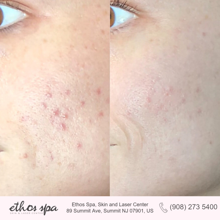 Before and after photo of acne scar removal