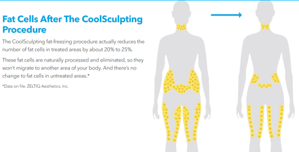 coolsculpting permanent fat removal