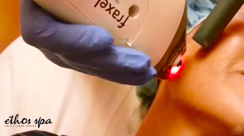 fraxel laser treatment on face