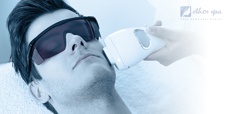 laser hair removal on the face for men