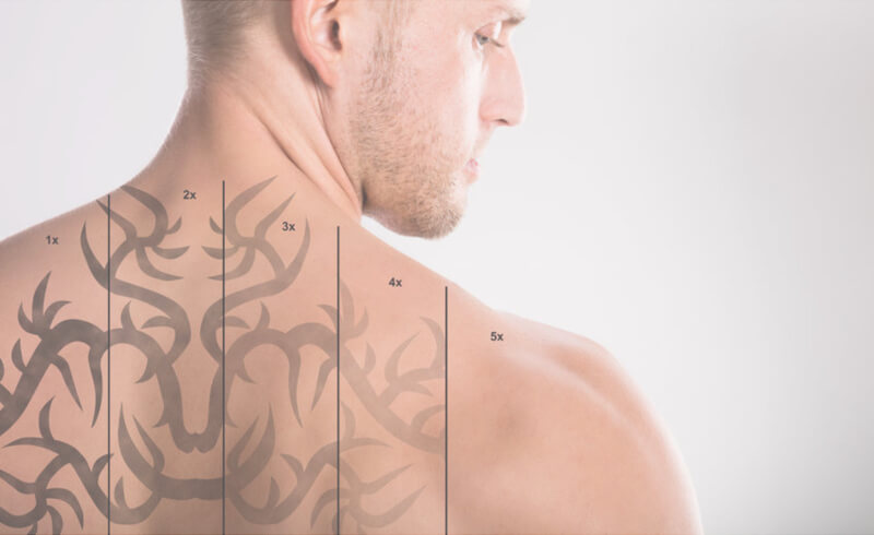 stages of tattoo removal on man's back